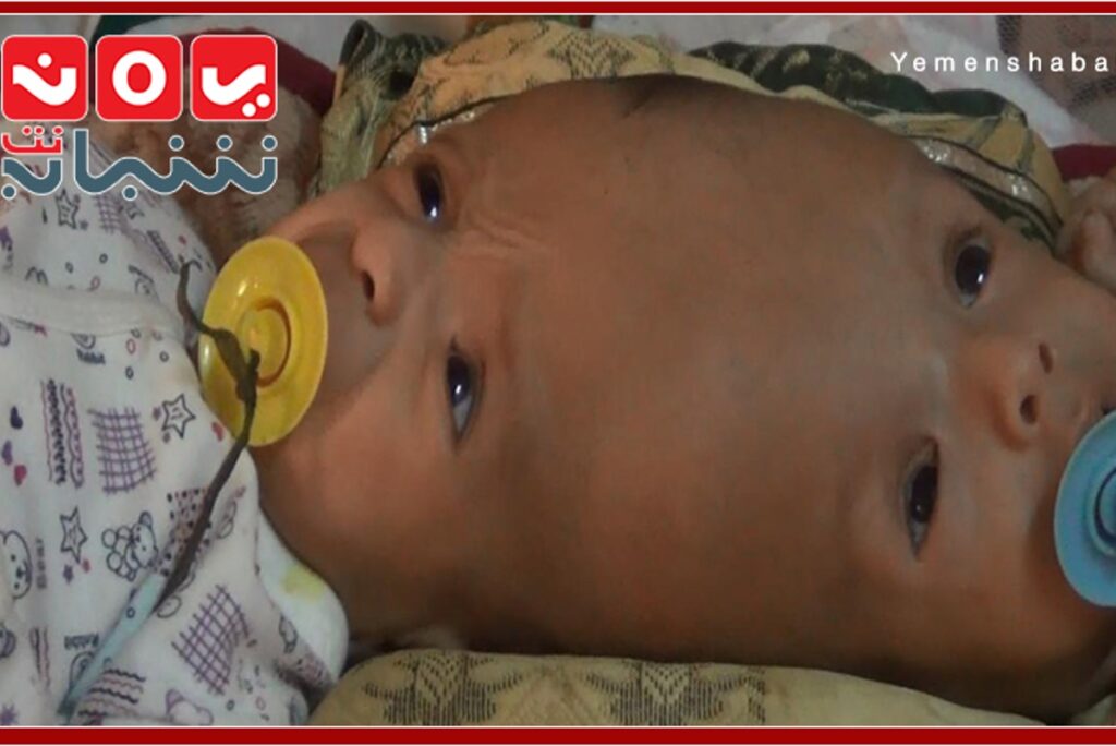 التوأم اليمني الملتصق